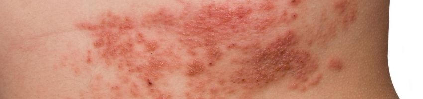 Disseminated Herpes: Definition, Cause, Symptoms and Treatments