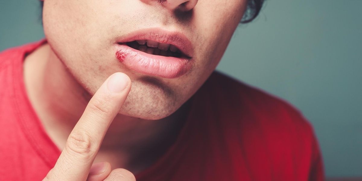 Avoid These Foods If You Have Cold Sores