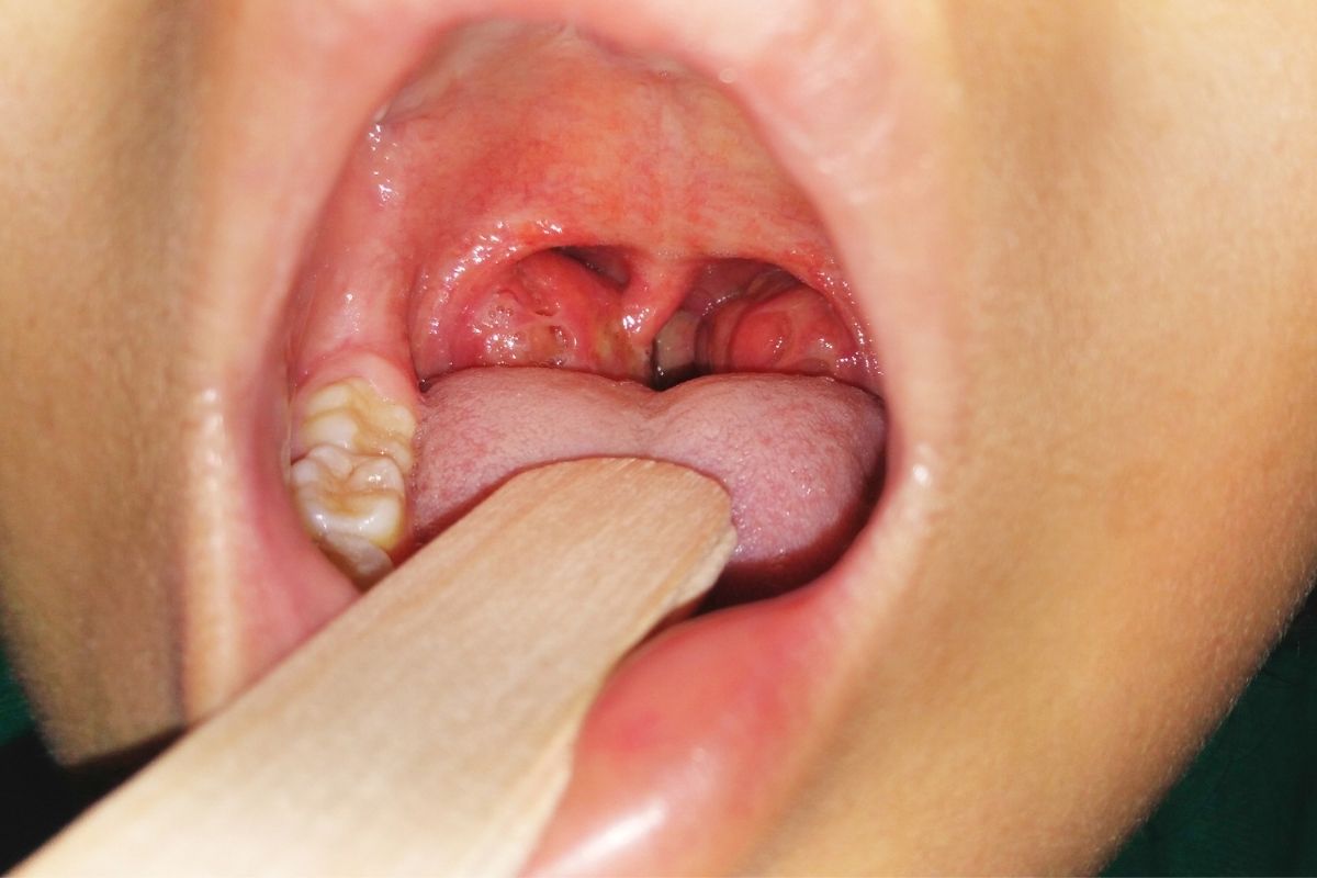What is Tonsil Ulceration? And Should I Be Worried?