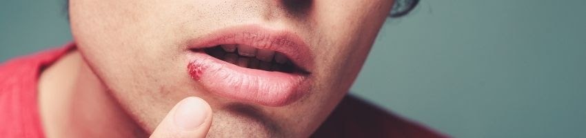 Can Stress Trigger Cold Sores?