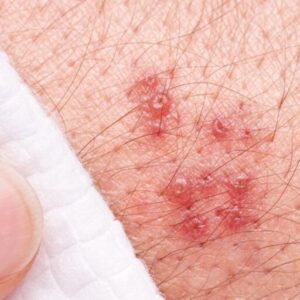 A herpes rash.