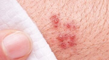 A herpes rash.