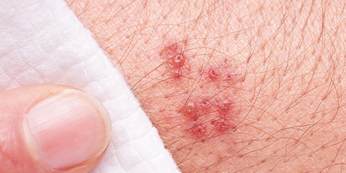 A herpes rash.