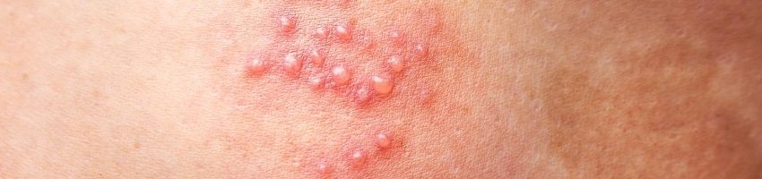 How to Tell If It’s a Herpes Rash