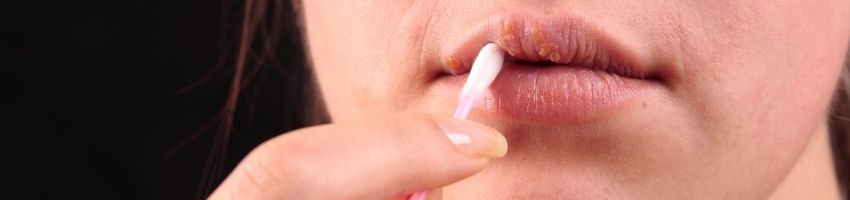 Avoid These Foods If You Have Cold Sores