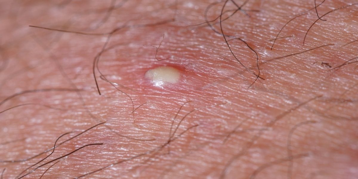 Ingrown Hair vs. Herpes: Know The Difference