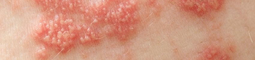 herpes outbreak pictures
