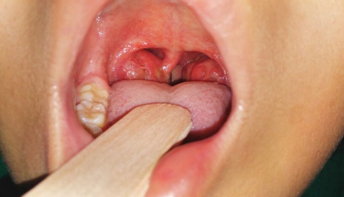 A picture of a human mouth and showing its tonsil ulceration