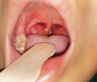 A picture of a human mouth and showing its tonsil ulceration